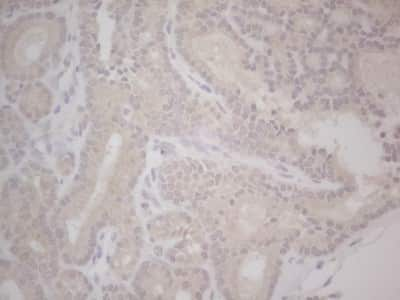 Immunohistochemistry: Lipin 1 Antibody (5B5) [NBP2-45671] - Analysis of Carcinoma of Human thyroid tissue. (Heat-induced epitope retrieval by Tris-EDTA, pH8.0) Dilution: 1:150