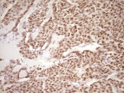 Immunohistochemistry: Lipin 1 Antibody (8F10) [NBP2-45670] - Analysis of Carcinoma of Human lung tissue. (Heat-induced epitope retrieval by 1 mM EDTA in 10mM Tris, pH8.5, 120C for 3min)