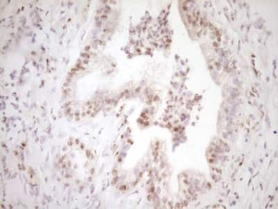 Immunohistochemistry: Lipin 1 Antibody (8F10) [NBP2-45670] - Analysis of Carcinoma of Human pancreas tissue. (Heat-induced epitope retrieval by 1 mM EDTA in 10mM Tris, pH8.5, 120C for 3min)