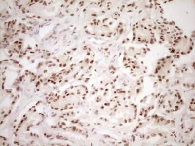 Immunohistochemistry: Lipin 1 Antibody (8F10) [NBP2-45670] - Analysis of Carcinoma of Human prostate tissue. (Heat-induced epitope retrieval by 1 mM EDTA in 10mM Tris, pH8.5, 120C for 3min)