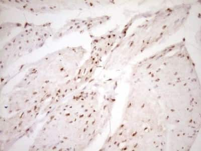 Immunohistochemistry: Lipin 1 Antibody (8F10) [NBP2-45670] - Analysis of Carcinoma of Human bladder tissue. (Heat-induced epitope retrieval by 1 mM EDTA in 10mM Tris, pH8.5, 120C for 3min)