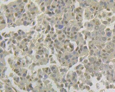 Immunohistochemistry: Lipin 1 Antibody (JG37-69) [NBP2-76845] - Immunohistochemical analysis of paraffin-embedded human liver cancer tissue using anti-Lipin 1 antibody. Counter stained with hematoxylin.