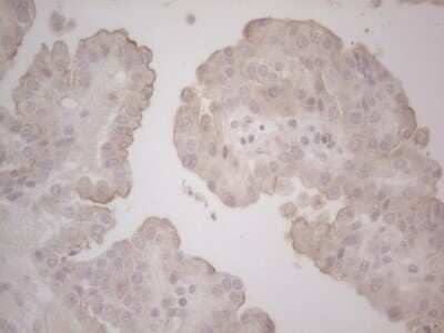 Immunohistochemistry: Lipin 1 Antibody (OTI5B5) - Azide and BSA Free [NBP2-71727] - Analysis of Adenocarcinoma of Human ovary tissue. (Heat-induced epitope retrieval by Tris-EDTA, pH8.0) Dilution: 1:150
