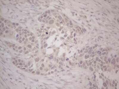 Immunohistochemistry: Lipin 1 Antibody (OTI5B5) - Azide and BSA Free [NBP2-71727] - Analysis of Carcinoma of Human kidney tissue. (Heat-induced epitope retrieval by Tris-EDTA, pH8.0)