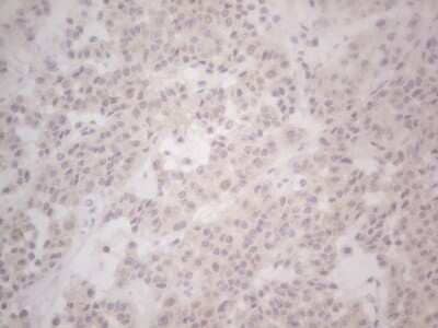 Immunohistochemistry: Lipin 1 Antibody (OTI5B5) - Azide and BSA Free [NBP2-71727] - Analysis of Carcinoma of Human lung tissue.(Heat-induced epitope retrieval by Tris-EDTA, pH8.0)