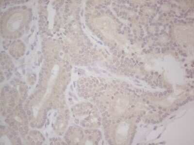Immunohistochemistry: Lipin 1 Antibody (OTI5B5) - Azide and BSA Free [NBP2-71727] - Analysis of Carcinoma of Human thyroid tissue. (Heat-induced epitope retrieval by Tris-EDTA, pH8.0) Dilution: 1:150
