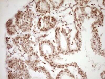 Immunohistochemistry: Lipin 1 Antibody (OTI8F10) - Azide and BSA Free [NBP2-71726] - Analysis of Adenocarcinoma of Human breast. (Heat-induced epitope retrieval by 1 mM EDTA in 10mM Tris, pH8.5, 120C for 3min)