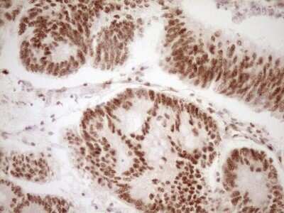 Immunohistochemistry: Lipin 1 Antibody (OTI8F10) - Azide and BSA Free [NBP2-71726] - Analysis of Adenocarcinoma of Human colon tissue. (Heat-induced epitope retrieval by 1 mM EDTA in 10mM Tris, pH8.5, 120C for 3min)