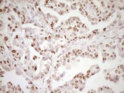 Immunohistochemistry: Lipin 1 Antibody (OTI8F10) - Azide and BSA Free [NBP2-71726] - Analysis of Adenocarcinoma of Human ovary tissue. (Heat-induced epitope retrieval by 1 mM EDTA in 10mM Tris, pH8.5, 120C for 3min)