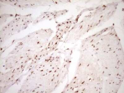 Immunohistochemistry: Lipin 1 Antibody (OTI8F10) - Azide and BSA Free [NBP2-71726] - Analysis of Carcinoma of Human bladder tissue. (Heat-induced epitope retrieval by 1 mM EDTA in 10mM Tris, pH8.5, 120C for 3min)