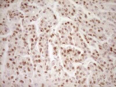 Immunohistochemistry: Lipin 1 Antibody (OTI8F10) - Azide and BSA Free [NBP2-71726] - Analysis of Carcinoma of Human liver tissue. (Heat-induced epitope retrieval by 1 mM EDTA in 10mM Tris, pH8.5, 120C for 3min)