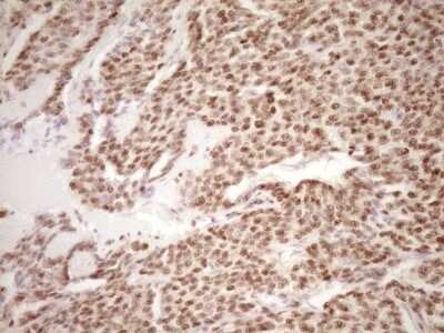 Immunohistochemistry: Lipin 1 Antibody (OTI8F10) - Azide and BSA Free [NBP2-71726] - Analysis of Carcinoma of Human lung tissue. (Heat-induced epitope retrieval by 1 mM EDTA in 10mM Tris, pH8.5, 120C for 3min)