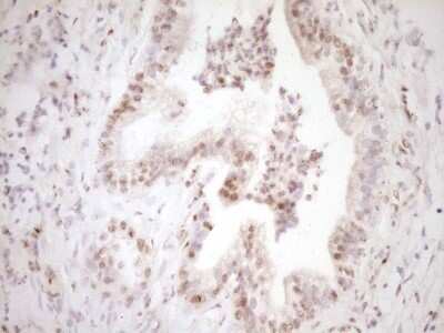 Immunohistochemistry: Lipin 1 Antibody (OTI8F10) - Azide and BSA Free [NBP2-71726] - Analysis of Carcinoma of Human pancreas tissue. (Heat-induced epitope retrieval by 1 mM EDTA in 10mM Tris, pH8.5, 120C for 3min)