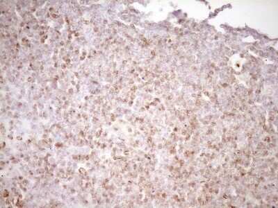 Immunohistochemistry: Lipin 1 Antibody (OTI8F10) - Azide and BSA Free [NBP2-71726] - Analysis of Human lymphoma tissue. (Heat-induced epitope retrieval by 1 mM EDTA in 10mM Tris, pH8.5, 120C for 3min)