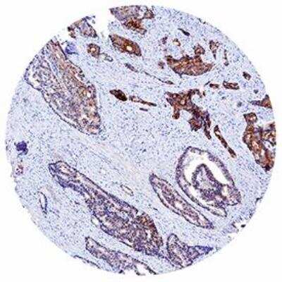 Immunohistochemistry-Paraffin: Lipocalin-2/NGAL Antibody (972737) [MAB17572] - Antibody was detected in immersion fixed paraffin-embedded sections of human prostate  cancer tissue.