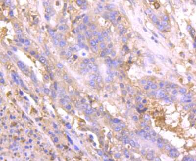 Immunohistochemistry-Paraffin: Lipocalin-2/NGAL Antibody (JM10-67) [NBP2-66935] - Analysis of paraffin-embedded human stomach cancer tissue using anti-Lipocalin-2 antibody. Counter stained with hematoxylin.