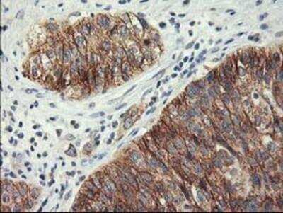 Immunohistochemistry-Paraffin: Lipoprotein Lipase/LPL Antibody (3A10) [NBP2-01395] - Carcinoma of Human bladder tissue using anti-Lipoprotein lipase mouse monoclonal antibody.