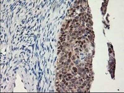 Immunohistochemistry: Lipoprotein Lipase/LPL Antibody (OTI3A10) - Azide and BSA Free [NBP2-71178] - Adenocarcinoma of Human ovary tissue using anti-Lipoprotein lipase mouse monoclonal antibody.