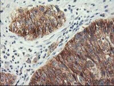 Immunohistochemistry: Lipoprotein Lipase/LPL Antibody (OTI3A10) - Azide and BSA Free [NBP2-71178] - Carcinoma of Human bladder tissue using anti-Lipoprotein lipase mouse monoclonal antibody.