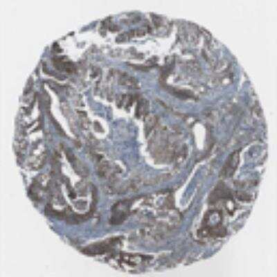 Immunohistochemistry: Liprin alpha 1 Antibody [21720002] - Most of the normal tissues displayed moderate cytoplasmic positivity which was occasionally accompanied with nuclear staining. Strong cytoplasmic staining was found in gastro-intestinal tract, gall bladder and endocrine glands. Malignant tissues generally exhibited moderate cytoplasmic immunoreactivity. A few cases of colo-rectal, endometrial, gastric and pancreatic cancers revealed strong staining while many skin cancers were weakly stained.  Image and statement courtesy of the Human Protein Atlas (HPA).