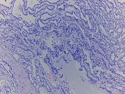 Hematoxylin & Eosin Stain: Liver Tissue Slides (Adenocarcinoma) [NBP2-77908] - Tissue: Human Liver,  Pathology: Adenocarcinoma