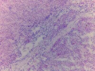 Hematoxylin & Eosin Stain: Liver Tissue Slides (Tumor) [NBP2-77638] - Tissue: Liver, Human, Tumorous