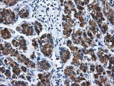 Immunohistochemistry: Livin Antibody (OTI1D12) - Azide and BSA Free [NBP2-72206] - Staining of paraffin-embedded Carcinoma of liver tissue using anti-Livin mouse monoclonal antibody.