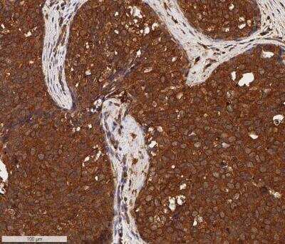 Immunohistochemistry-Paraffin: Lung Cancer Metastasis Antibody Pack [NBP1-78949] - IHC analysis of a formalin fixed paraffin-embedded (FFPE) human breast cancer using 5ug/ml conc. of Cytokeratin 1 antibody (NB100-2756, clone LHK1) on a Bond Rx autostainer (Leica Biosystems). The assay involved 20 minutes of heat induced antigen retrieval (HIER) using 10mM sodium citrate buffer (pH 6.0) and endogenous peroxidase quenching with peroxide block. The sections were incubated with primary antibody for 30 minutes and Bond Polymer Refine Detection (Leica Biosystems) with DAB was used for signal development followed by counterstaining with hematoxylin. Whole slide scanning and capturing of representative images (20X) was performed using Aperio AT2 (Leica Biosystems). A membrane-cytoplasmic staining of Cytokeratin 1 was observed in the cancer cells with signal localized more to the cell membranes. Tumor stroma was mostly negative for Cytokeratin 1. Staining was performed by Histowiz.