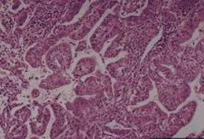 Hematoxylin & Eosin Stain: Lung Tissue Slides (Bronchioloalveolar Carcinoma) [NBP2-30282] - lung, bronchioloalveolar carcinoma  Age/Sex : 67/M