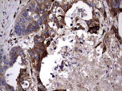 Immunohistochemistry-Paraffin: Lysine Hydroxylase 2/PLOD2 Antibody (6D1) [NBP2-46451] - Analysis of Adenocarcinoma of Human colon tissue.