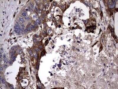 Immunohistochemistry: Lysine Hydroxylase 2/PLOD2 Antibody (OTI6D1) - Azide and BSA Free [NBP2-72556] - Analysis of Adenocarcinoma of Human colon tissue.