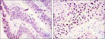 Immunohistochemistry-Paraffin: Lysine (K)-specific Demethylase 3A/KDM3A/JMJD1A Antibody (1E12) - Azide and BSA Free [NBP2-80839] - Immunohistochemical analysis of paraffin-embedded colonic cancer tissues (left) and lung cancer tissues (right) using JMJD1A mouse mAb with DAB staining. Image from the standard format of this antibody.