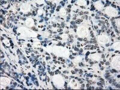 Immunohistochemistry: Lysine (K)-specific Demethylase 4C/KDM4C/JMJD2C Antibody (OTI5B9) - Azide and BSA Free [NBP2-72553] - Staining of paraffin-embedded Adenocarcinoma of ovary tissue using anti-JMJD2C mouse monoclonal antibody.