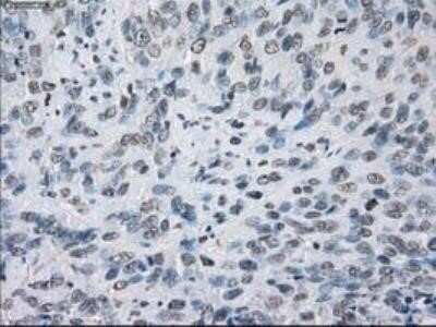 Immunohistochemistry: Lysine (K)-specific Demethylase 4C/KDM4C/JMJD2C Antibody (OTI5B9) - Azide and BSA Free [NBP2-72553] - Staining of paraffin-embedded Carcinoma of thyroid tissue using anti-JMJD2C mouse monoclonal antibody.