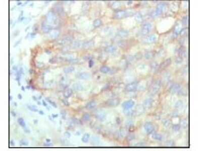 Immunohistochemistry-Paraffin: Lysyl tRNA synthetase Antibody (8G12C1) [NBP1-47417] - Analysis of human cervical carcinoma, showing cytoplasmic localization with DAB staining using KARS mouse mAb.