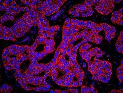 Immunocytochemistry/Immunofluorescence: Lysyl tRNA synthetase Antibody [NB100-1719] - FFPE section of human breast carcinoma. Affinity purified rabbit anti-Lysyl tRNA synthetase used at a dilution of 1:100.