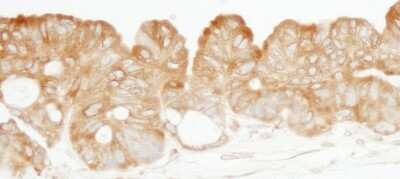 Immunohistochemistry: Lysyl tRNA synthetase Antibody [NB100-1719] - Sample: FFPE section of human ovarian carcinoma. Antibody: Affinity purified rabbit anti-KARS used at a dilution of 1:200 (1ug/ml). Detection: DAB