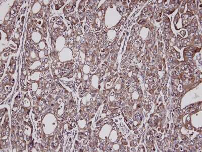 Immunohistochemistry-Paraffin: Lysyl tRNA synthetase Antibody [NBP1-32063] - Paraffin-embedded NCI-N87 xenograft, using antibody at 1:100 dilution.