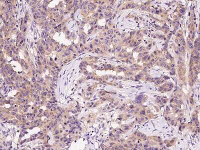 Immunohistochemistry-Paraffin: Lysyl tRNA synthetase Antibody [NBP2-99362] - Immunochemical staining of human Lysyl tRNA synthetase in human breast carcinoma with rabbit polyclonal antibody at 1:1000 dilution, formalin-fixed paraffin embedded sections.