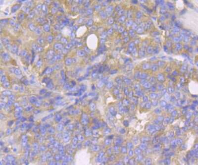 Immunohistochemistry-Paraffin: Lysyl tRNA synthetase Antibody (JE40-55) [NBP2-75560] - Analysis of paraffin-embedded human prostate cancer tissue using anti-Lysyl tRNA synthetase antibody. Counter stained with hematoxylin.
