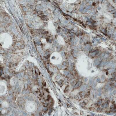 Immunohistochemistry: MACC1 Antibody (CL0856) [NBP2-52955] - Staining of human colorectal cancer shows moderate cytoplasmic immunoreactivity in tumor cells.