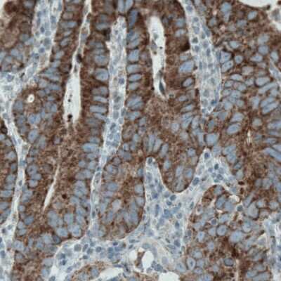 Immunohistochemistry-Paraffin: MACC1 Antibody (CL0856) [NBP2-52955] - Staining of human stomach cancer shows strong positivity in tumor cells.