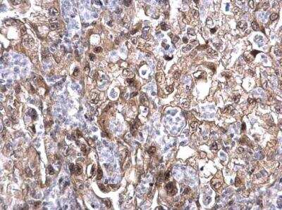 Immunohistochemistry-Paraffin: MAF1 Antibody [NBP1-31617] -  Human endometrial carcinoma.  MAF1 antibody dilution: 1:500. Antigen Retrieval: Trilogy™ (EDTA based, pH 8.0) buffer, 15min