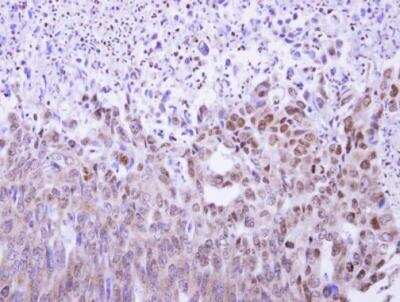 Immunohistochemistry-Paraffin: MAF1 Antibody [NBP1-31617] - Human colon carcinoma.  MAF1 antibody dilution: 1:500. Antigen Retrieval: Trilogy™ (EDTA based, pH 8.0) buffer, 15min