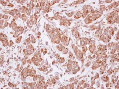 Immunohistochemistry-Paraffin: MAGEA4 Antibody [NBP2-17204] - Human breast cancer, using MAGEA4 antibody at 1:500 dilution. Antigen Retrieval: Trilogy™ (EDTA based, pH 8.0) buffer, 15min.