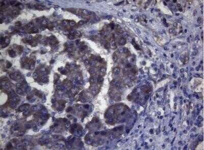 Immunohistochemistry: MAK Antibody (OTI5A7) - Azide and BSA Free [NBP2-72580] - Staining of paraffin-embedded Carcinoma of Human liver tissue using anti-MAK mouse monoclonal antibody.