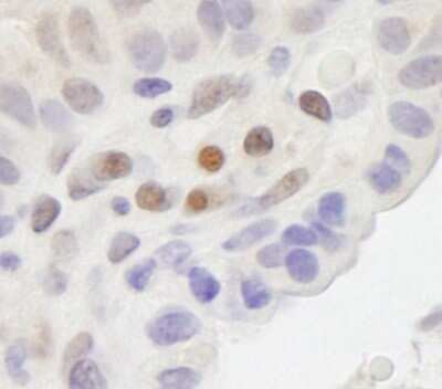 <b>Independent Antibodies Validation and Biological Strategies Validation.</b>Immunohistochemistry-Paraffin: MAML2 Antibody [NB100-2127] - Human breast carcinoma. Antibody: Affinity purified rabbit anti-MAML2 used at a dilution of 1:200 (1ug/ml). Detection: DAB