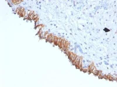 Immunohistochemistry-Paraffin: MAML2 Antibody (MAML2/1302) - Azide and BSA Free [NBP2-54588] - Formalin-fixed, paraffin-embedded Human Bladder Carcinoma stained with MAML2 Monoclonal Antibody (MAML2/1302).