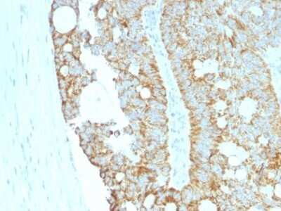 Immunohistochemistry-Paraffin: MAML2 Antibody (MAML2/1302) - Azide and BSA Free [NBP2-54588] - Formalin-fixed, paraffin-embedded Human Colon Carcinoma stained with MAML2 Monoclonal Antibody (MAML2/1302).