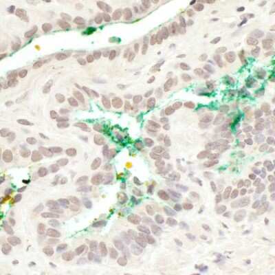 <b>Biological Strategies Validation. </b>Immunohistochemistry-Paraffin: MAML3 Antibody [NB100-2128] - Sample: FFPE section of human prostate carcinoma. Antibody: Affinity purified rabbit anti-MAML3 (NB100-2128). Detection: DAB